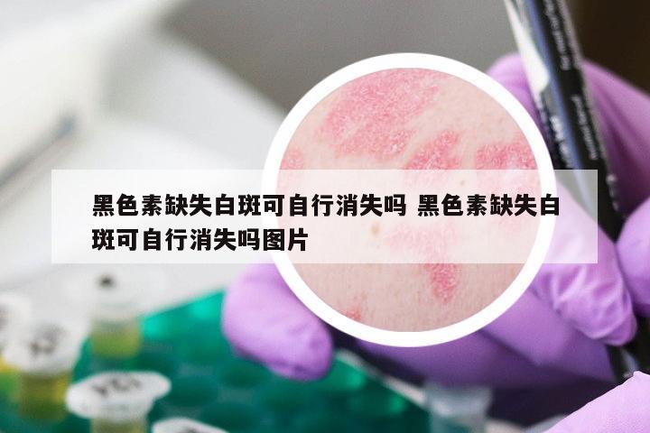 黑色素缺失白斑可自行消失吗 黑色素缺失白斑可自行消失吗图片