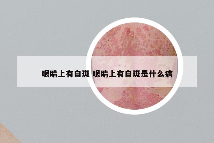 眼睛上有白斑 眼睛上有白斑是什么病