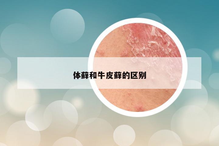 体藓和牛皮藓的区别