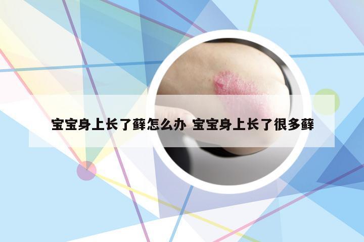 宝宝身上长了藓怎么办 宝宝身上长了很多藓