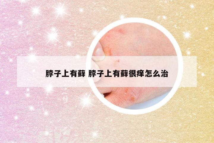 脖子上有藓 脖子上有藓很痒怎么治
