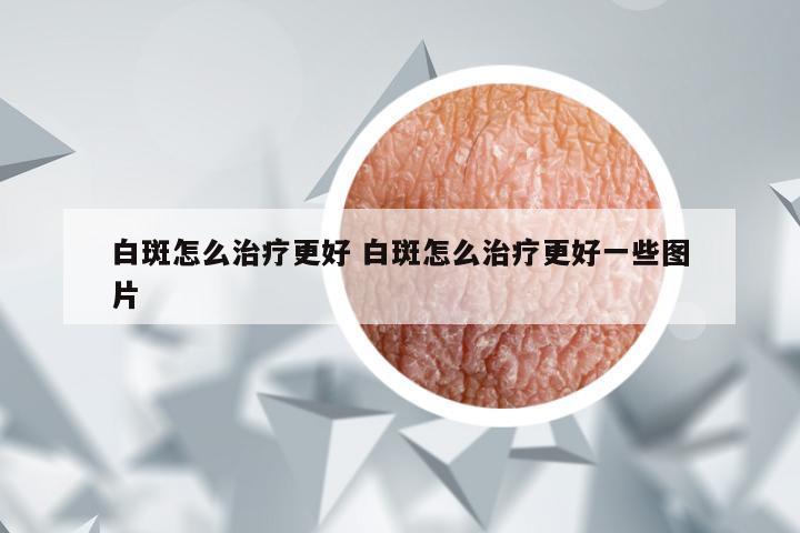 白斑怎么治疗更好 白斑怎么治疗更好一些图片