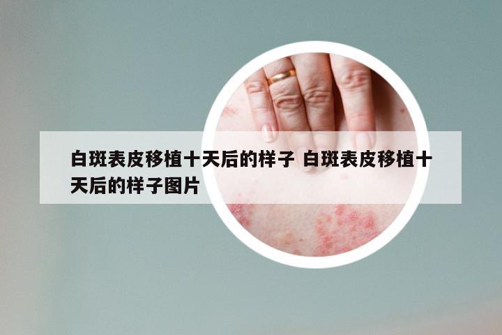 白斑表皮移植十天后的样子 白斑表皮移植十天后的样子图片