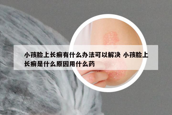 小孩脸上长癣有什么办法可以解决 小孩脸上长癣是什么原因用什么药