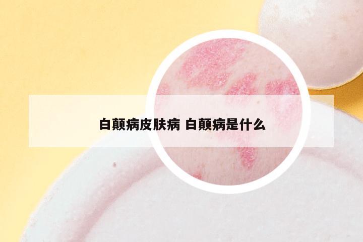 白颠病皮肤病 白颠病是什么