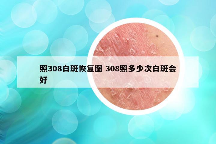 照308白斑恢复图 308照多少次白斑会好