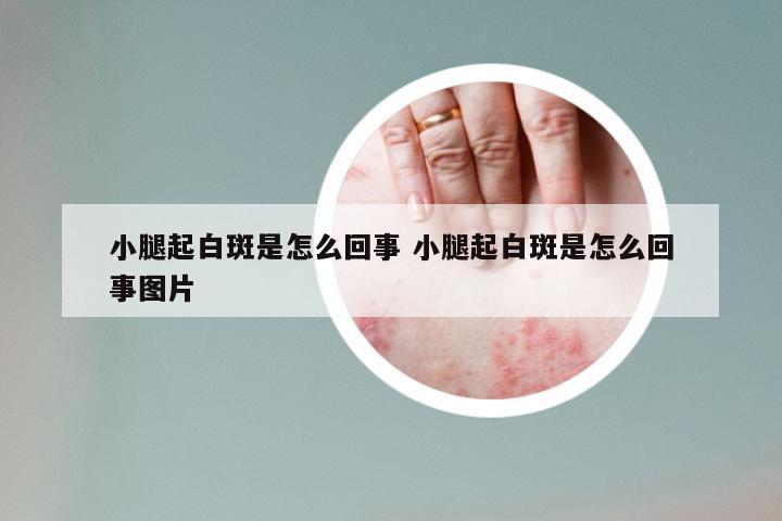 小腿起白斑是怎么回事 小腿起白斑是怎么回事图片