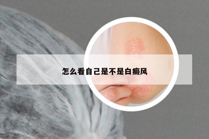 怎么看自己是不是白癜风