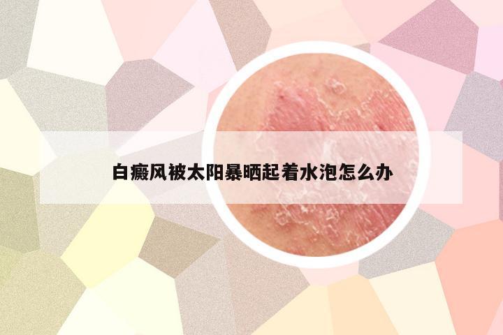 白癜风被太阳暴晒起着水泡怎么办