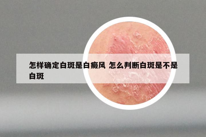怎样确定白斑是白癜风 怎么判断白斑是不是白斑