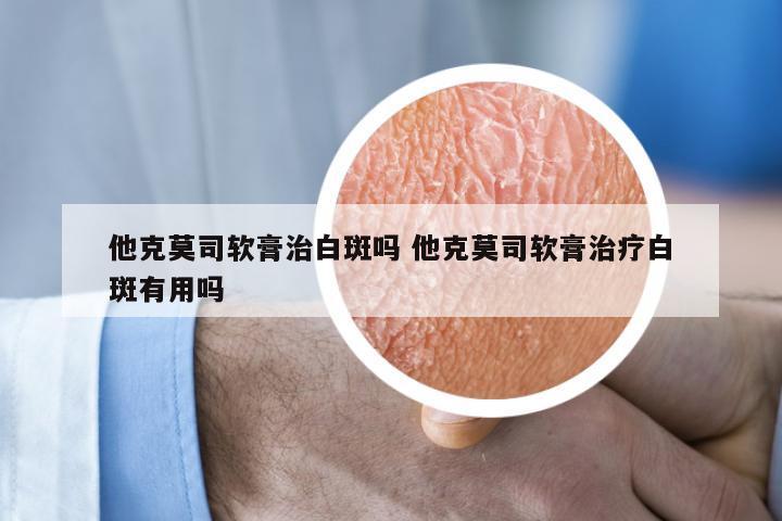 他克莫司软膏治白斑吗 他克莫司软膏治疗白斑有用吗