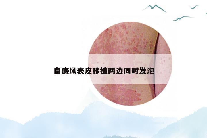 白癜风表皮移植两边同时发泡