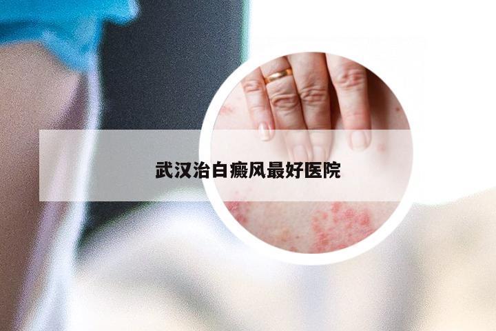 武汉治白癜风最好医院