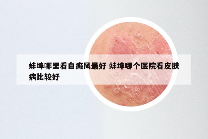 蚌埠哪里看白癜风最好 蚌埠哪个医院看皮肤病比较好