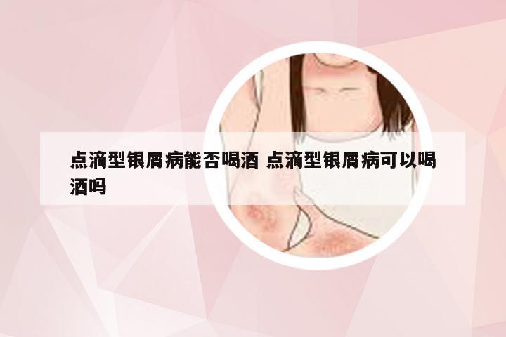 点滴型银屑病能否喝酒 点滴型银屑病可以喝酒吗