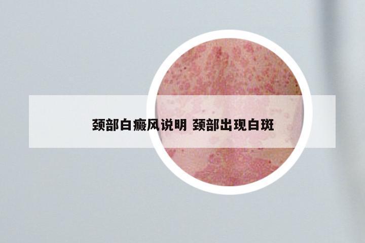颈部白癜风说明 颈部出现白斑