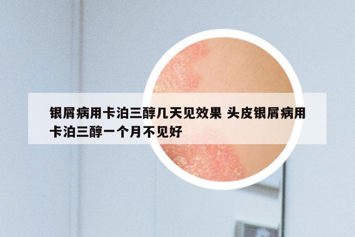 银屑病用卡泊三醇几天见效果 头皮银屑病用卡泊三醇一个月不见好