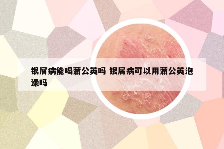 银屑病能喝蒲公英吗 银屑病可以用蒲公英泡澡吗