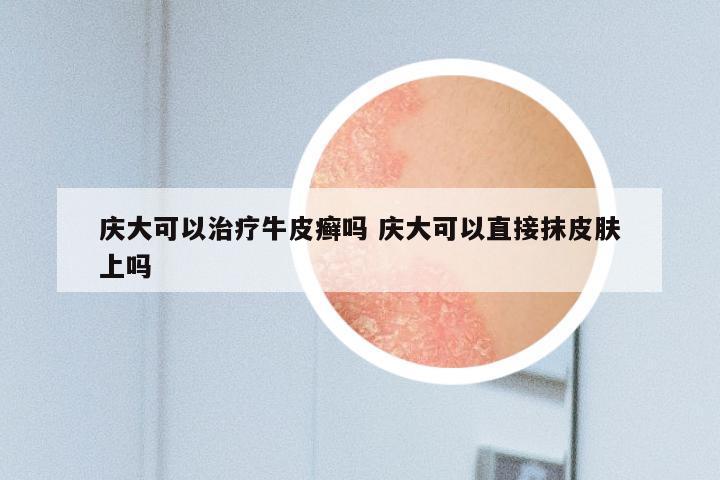 庆大可以治疗牛皮癣吗 庆大可以直接抹皮肤上吗