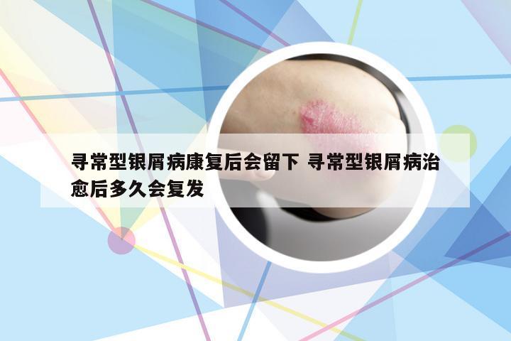 寻常型银屑病康复后会留下 寻常型银屑病治愈后多久会复发