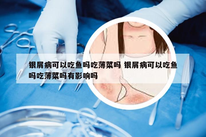 银屑病可以吃鱼吗吃薄菜吗 银屑病可以吃鱼吗吃薄菜吗有影响吗