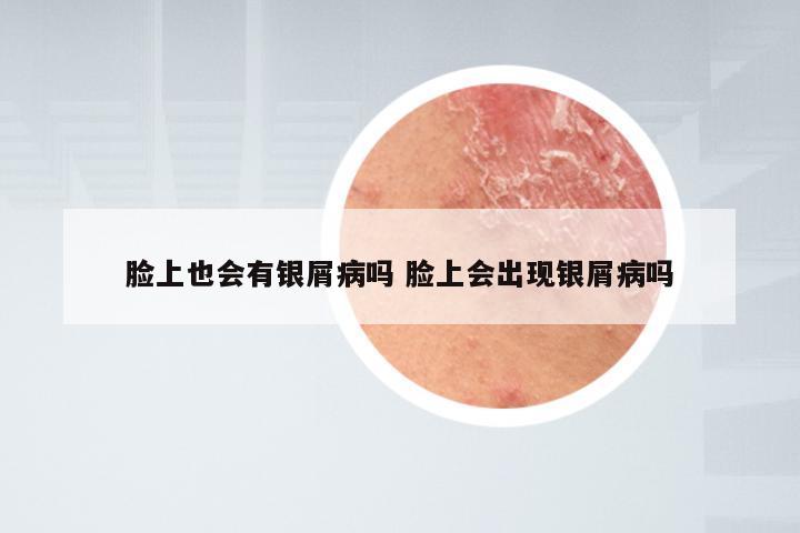 脸上也会有银屑病吗 脸上会出现银屑病吗