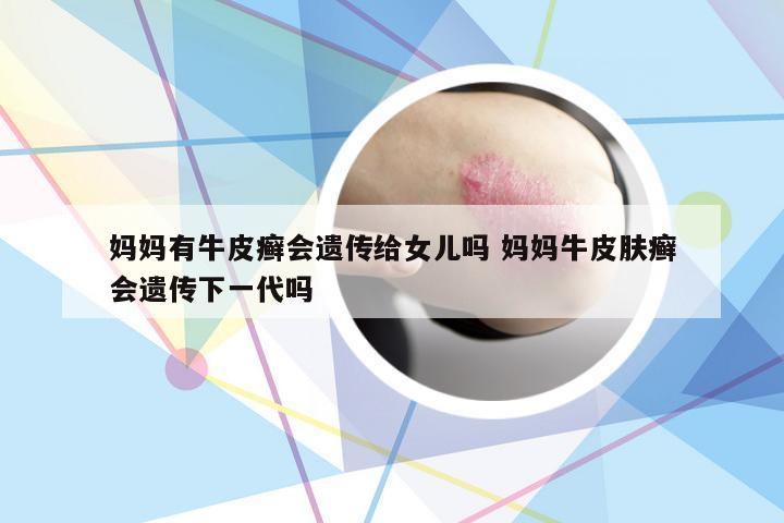 妈妈有牛皮癣会遗传给女儿吗 妈妈牛皮肤癣会遗传下一代吗