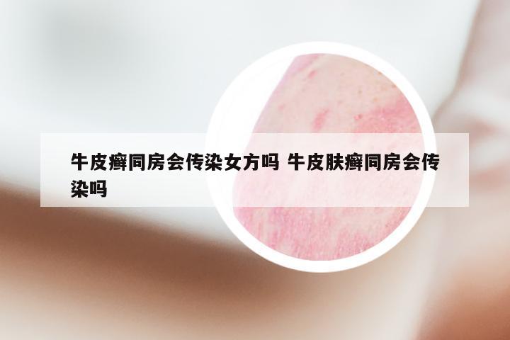 牛皮癣同房会传染女方吗 牛皮肤癣同房会传染吗