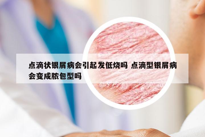 点滴状银屑病会引起发低烧吗 点滴型银屑病会变成脓包型吗
