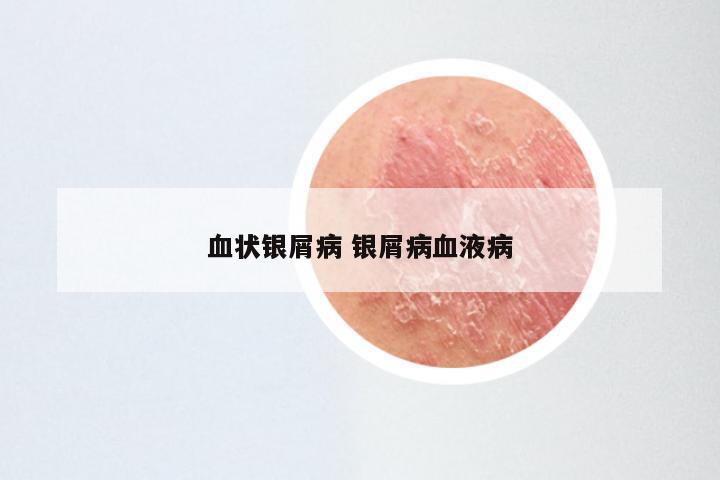 血状银屑病 银屑病血液病
