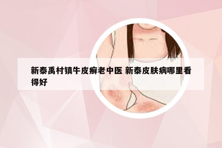 新泰禹村镇牛皮癣老中医 新泰皮肤病哪里看得好