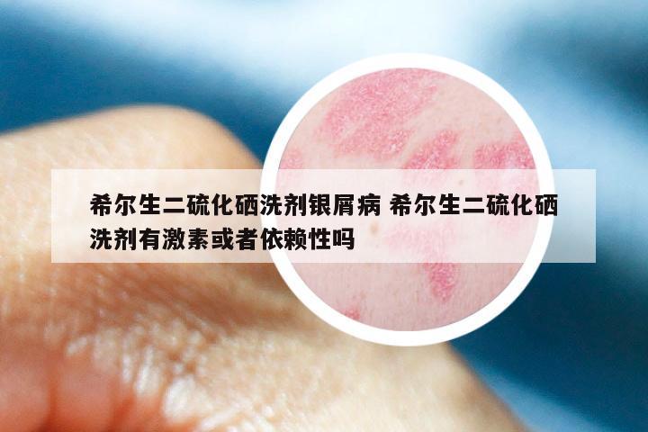希尔生二硫化硒洗剂银屑病 希尔生二硫化硒洗剂有激素或者依赖性吗