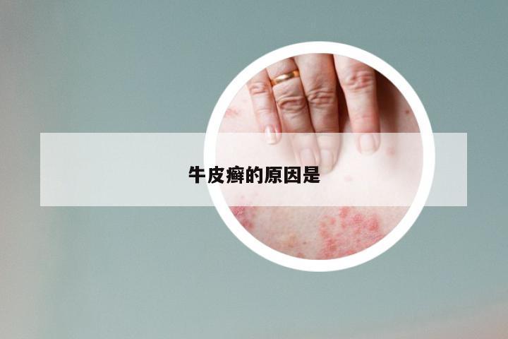 牛皮癣的原因是