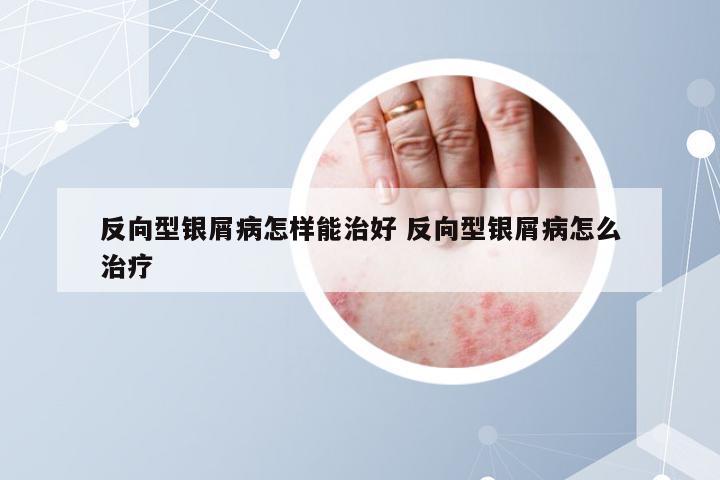 反向型银屑病怎样能治好 反向型银屑病怎么治疗