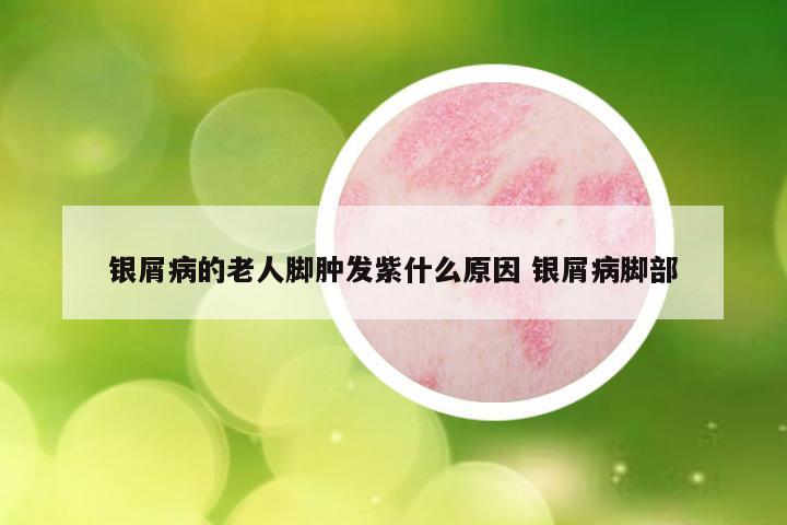 银屑病的老人脚肿发紫什么原因 银屑病脚部