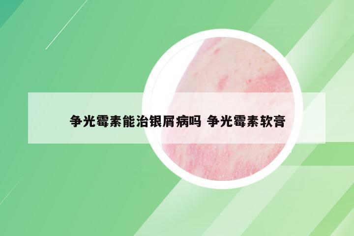 争光霉素能治银屑病吗 争光霉素软膏