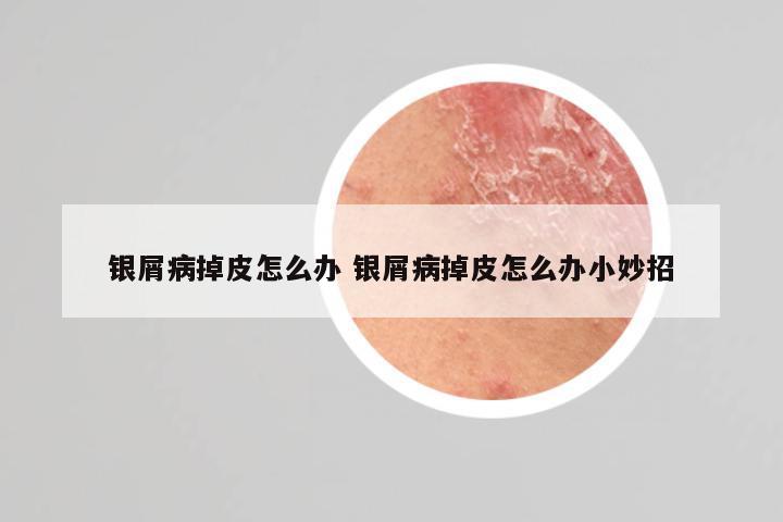 银屑病掉皮怎么办 银屑病掉皮怎么办小妙招