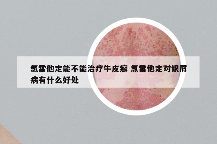 氯雷他定能不能治疗牛皮癣 氯雷他定对银屑病有什么好处