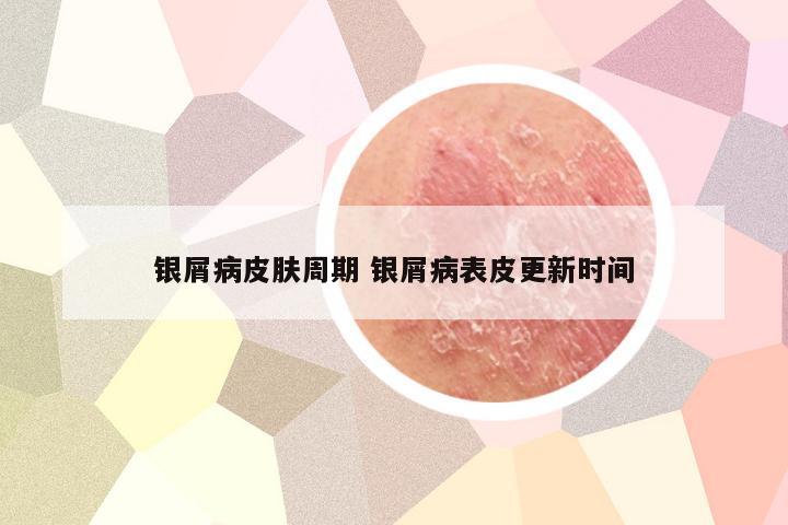 银屑病皮肤周期 银屑病表皮更新时间