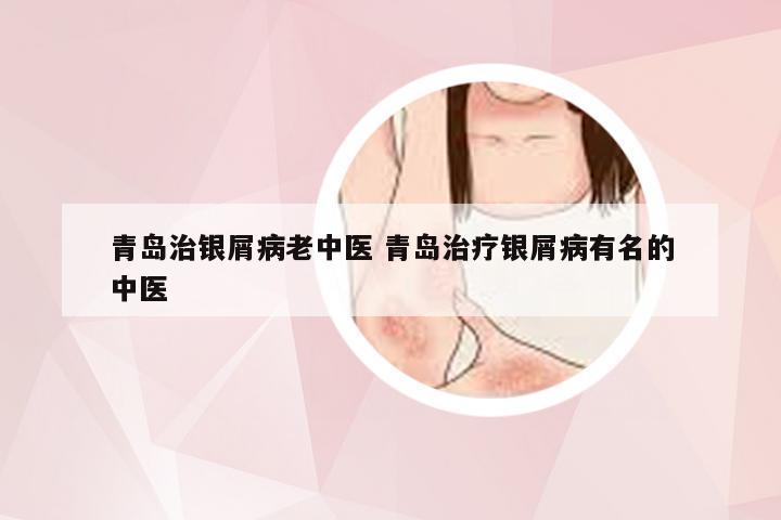 青岛治银屑病老中医 青岛治疗银屑病有名的中医