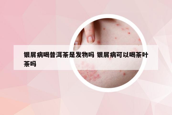 银屑病喝普洱茶是发物吗 银屑病可以喝茶叶茶吗