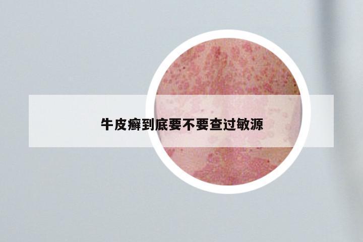 牛皮癣到底要不要查过敏源