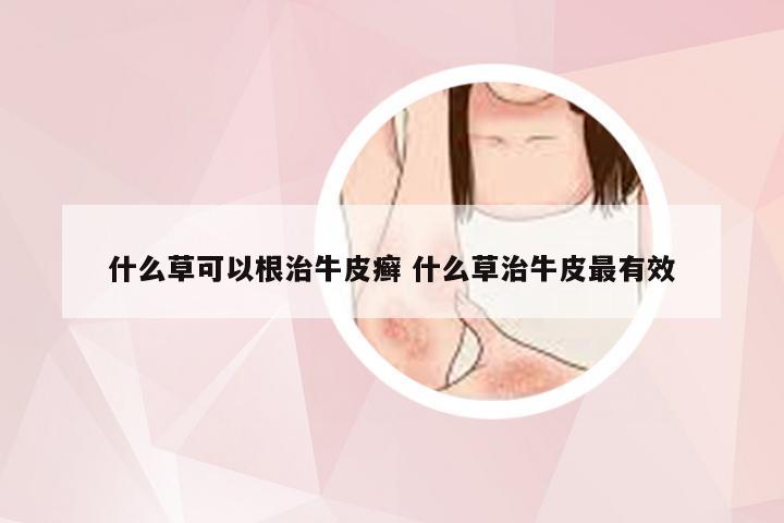 什么草可以根治牛皮癣 什么草治牛皮最有效