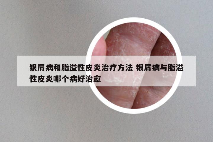 银屑病和脂溢性皮炎治疗方法 银屑病与脂溢性皮炎哪个病好治愈