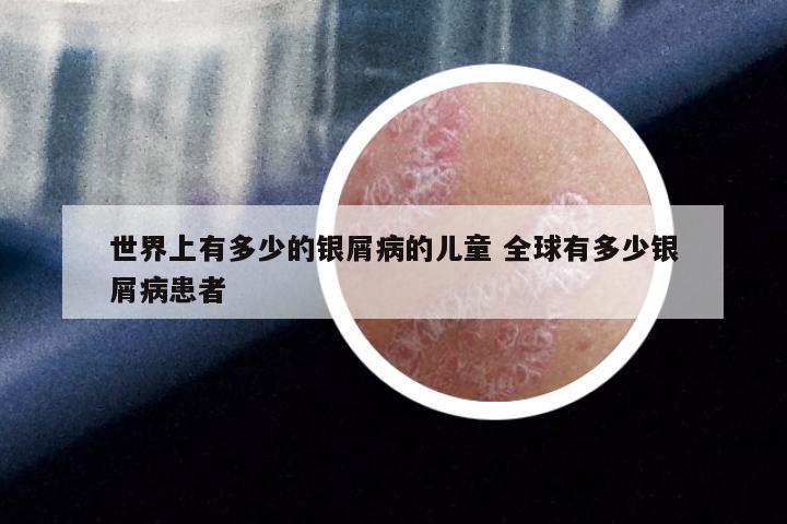世界上有多少的银屑病的儿童 全球有多少银屑病患者