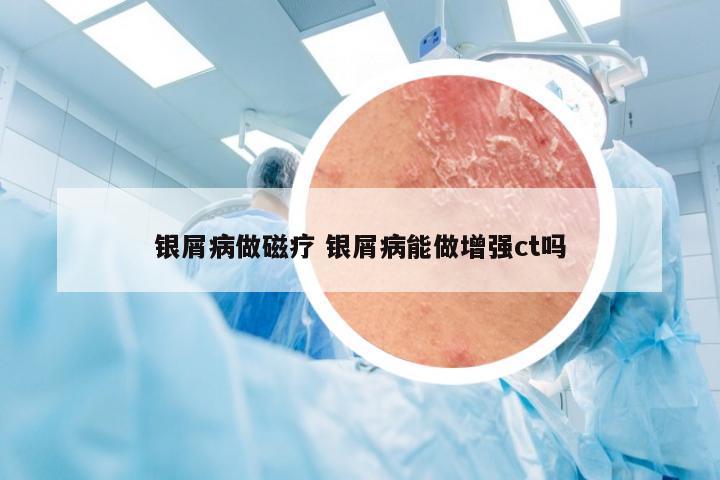 银屑病做磁疗 银屑病能做增强ct吗