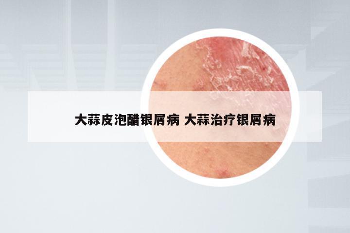 大蒜皮泡醋银屑病 大蒜治疗银屑病