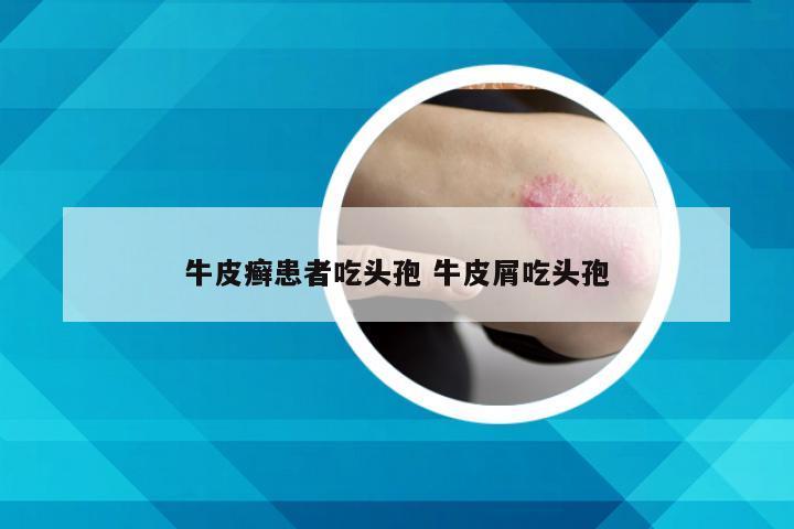 牛皮癣患者吃头孢 牛皮屑吃头孢