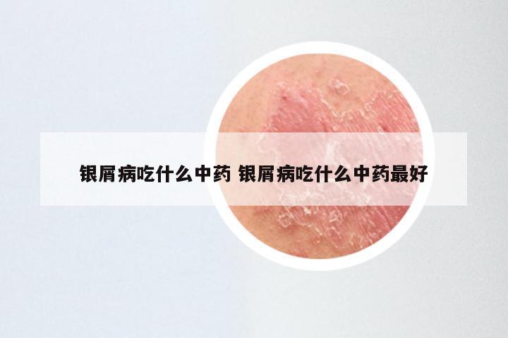 银屑病吃什么中药 银屑病吃什么中药最好