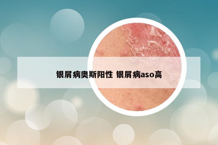 银屑病奥斯阳性 银屑病aso高
